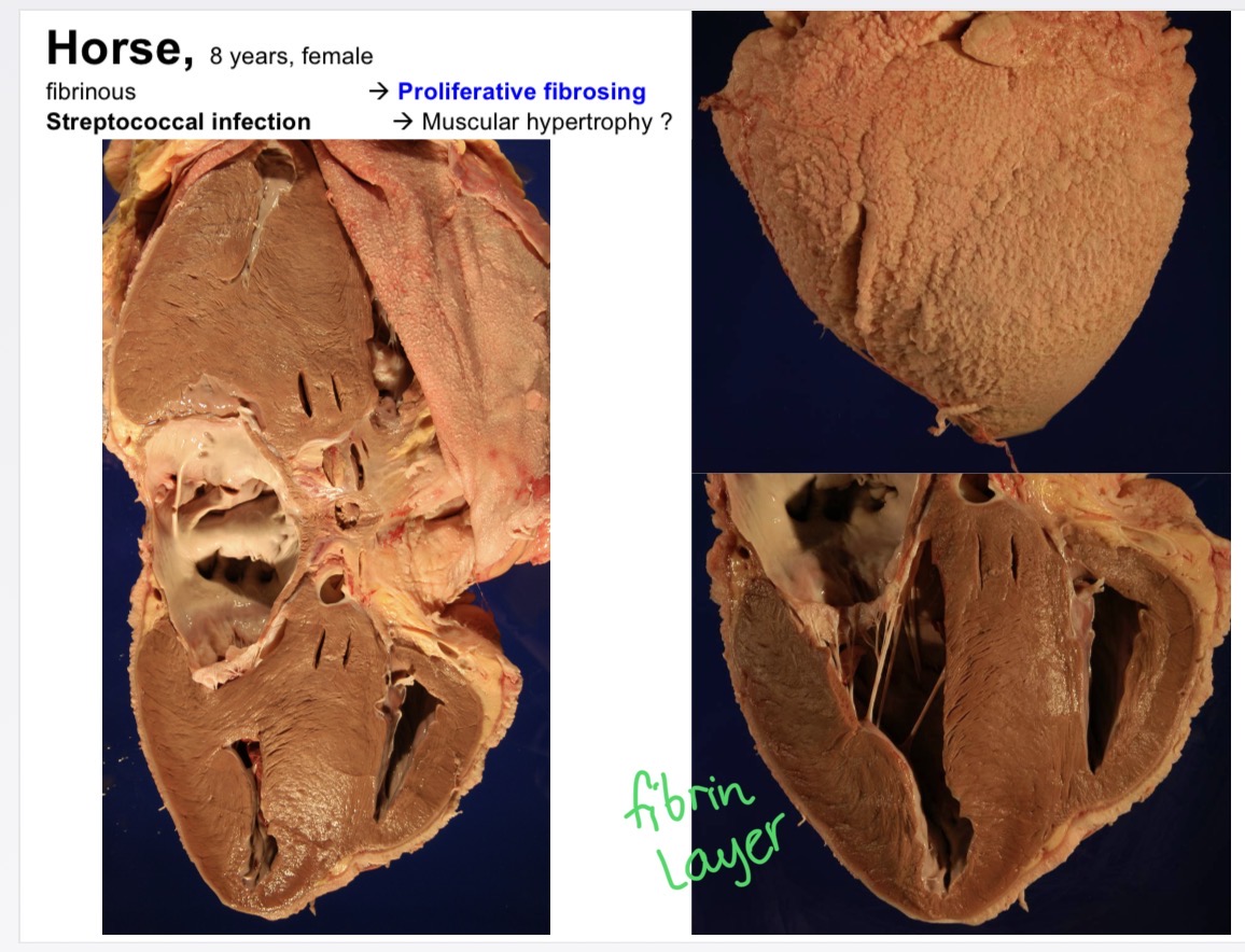 <p>fibrinous pericarditis in streptococcus inf </p>