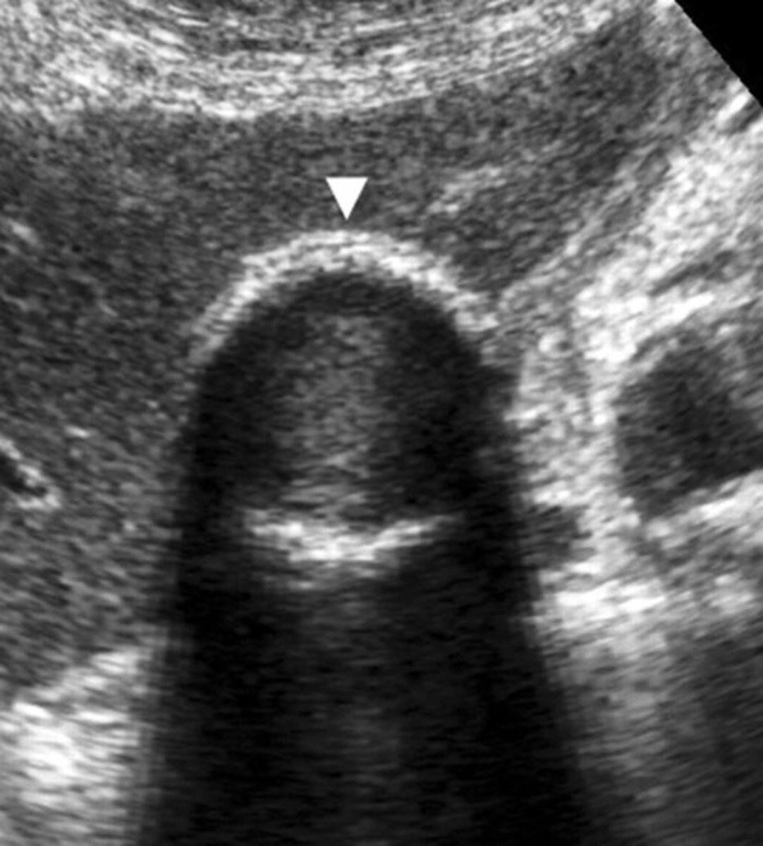 <p>-bright echogenic echo with posterior shadowing, </p><p>-no WES sign just the "ES"- echo and shadow only</p><p>-Identifing calcification of the posterior GB wall is helpful to differeniate porcelain BG from WES sign. </p><p>if it was WES sign the posterior wall would be shadowed out!</p>