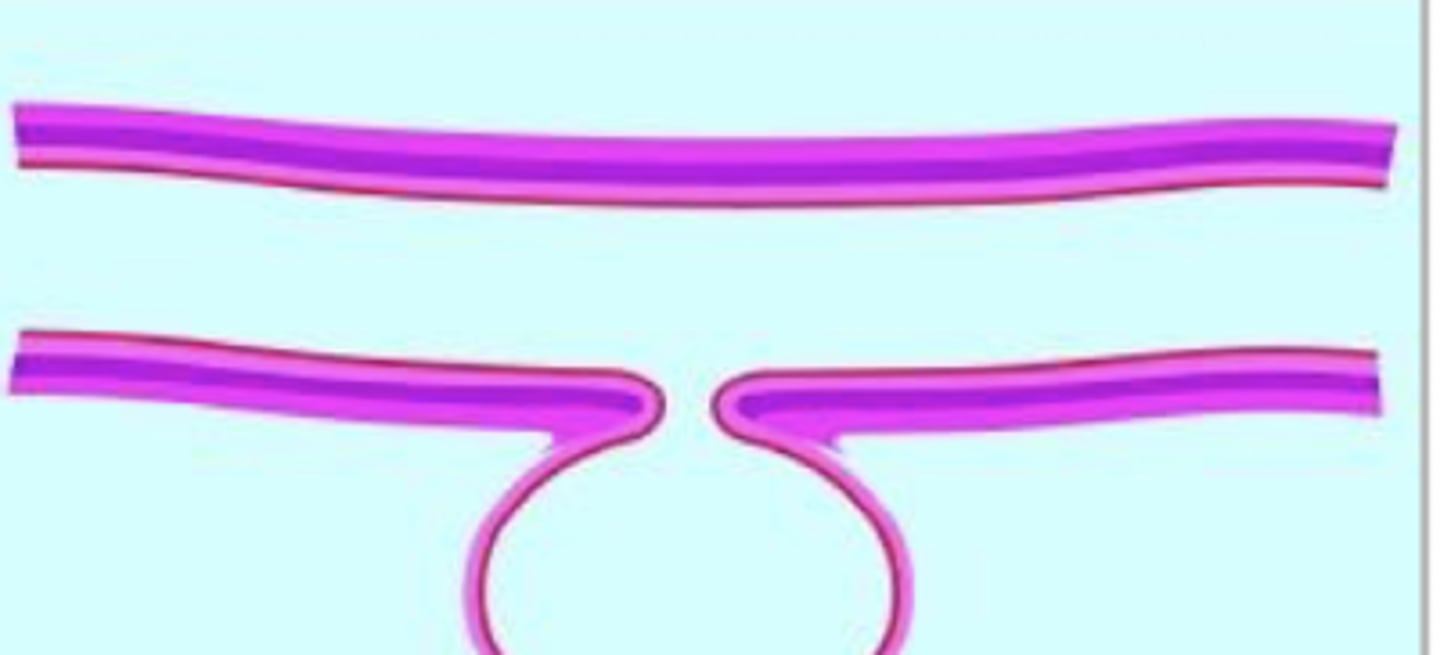 <p>ID type of diverticulum</p>