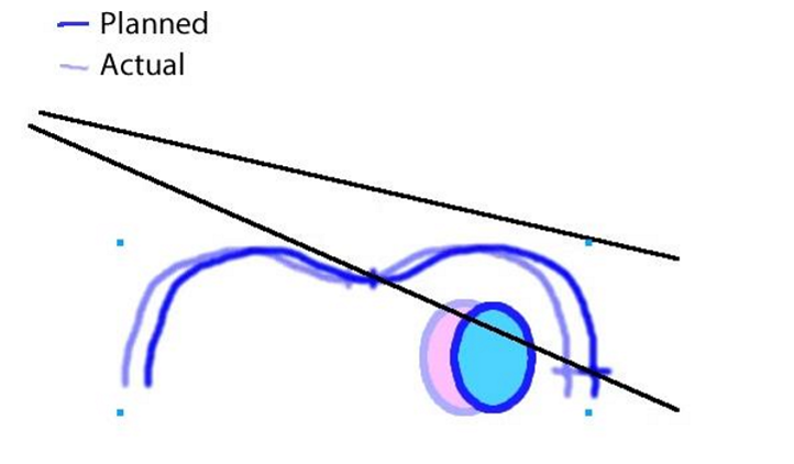 <p>the isocenter is too lateral and the patient is too medial and the lung is actually getting less dose then what is planned</p>