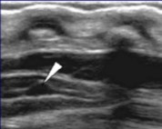 <p>The tip of the arrow points to a normal variant. What can be assumed here?</p>