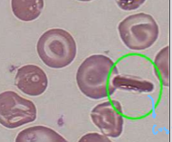 <p>Intracellular crystallization of hgb C</p>