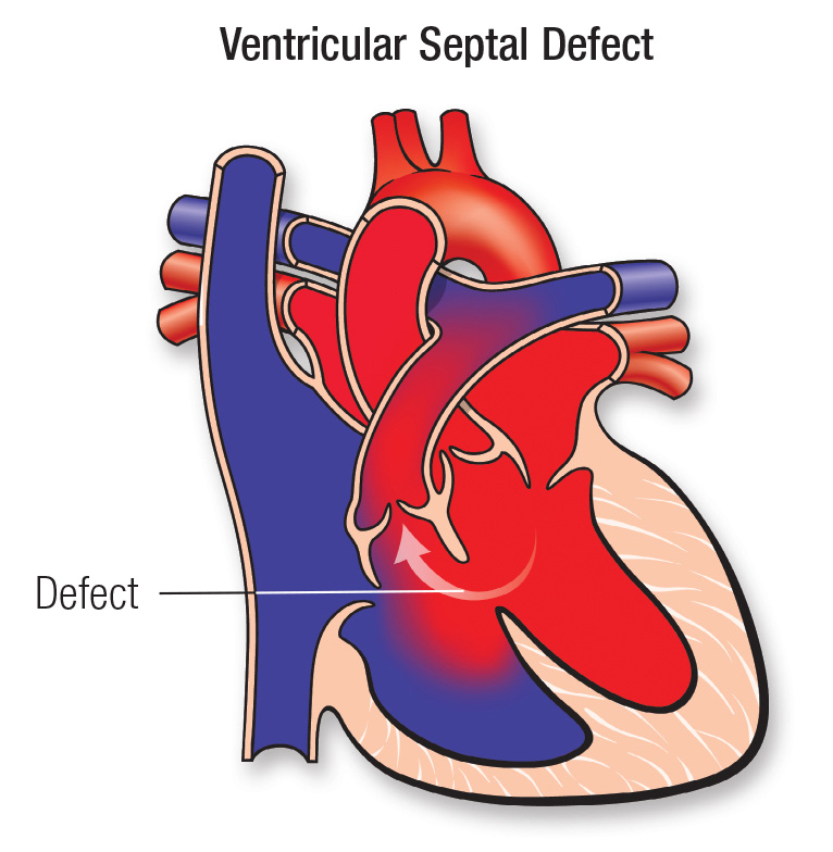 <p>Ventricular Septal defect</p>