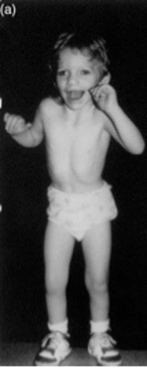 <p>Seizures, strabismus, sociable w/ episodic laughter.</p>