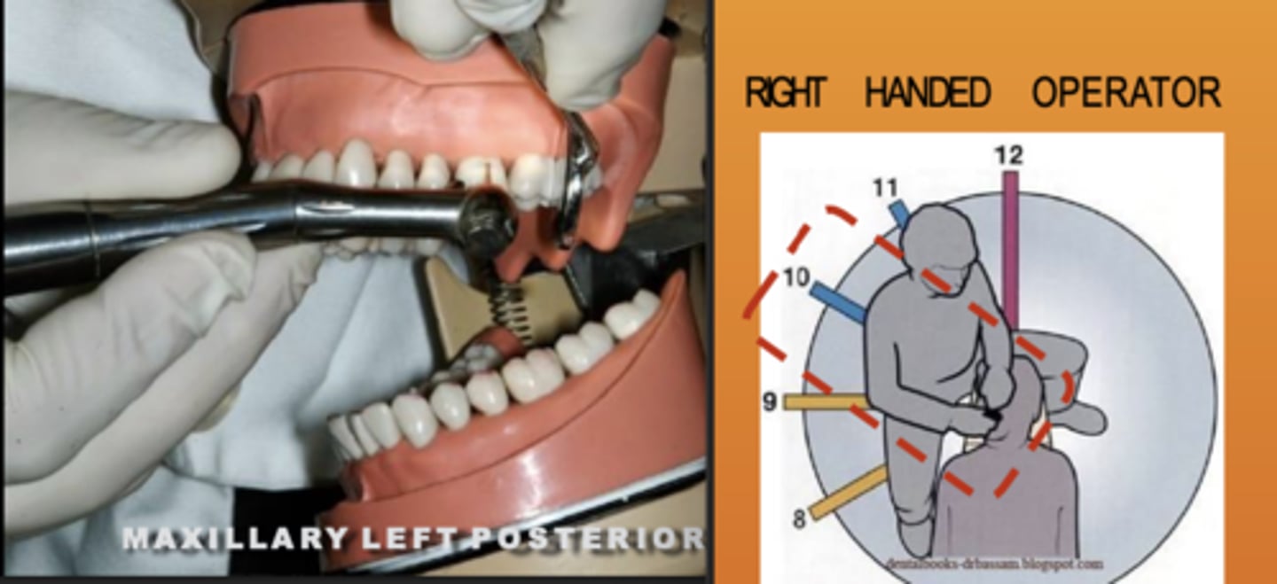 <p>Zone: 10</p><p>Vision: Direct</p><p>Patient's Head: Right</p><p>Fulcrum: Max anteriors (I)</p>