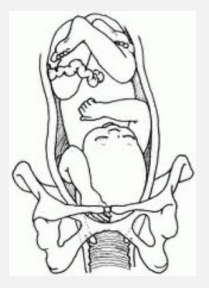 <p><strong>Compound Presentation</strong></p><p>-Prolapse of fetal ________ alongside a presenting part </p><ul><li><p>____ up by the head</p></li></ul><p>-Increased risk of ____ prolapse</p><p>-Risk of _______-vaginal delivery </p><ul><li><p>Perineal tears </p></li></ul><p></p>