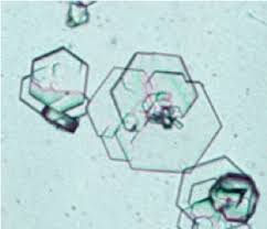 <ul><li><p>colorless</p></li><li><p>hexagonal</p></li><li><p>associated with metabolic defect</p></li></ul><p></p>