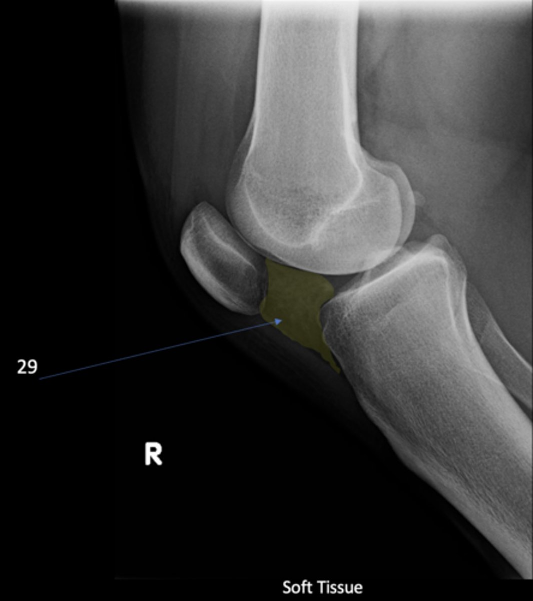 <p>Another term for infrapatellar pouch</p>