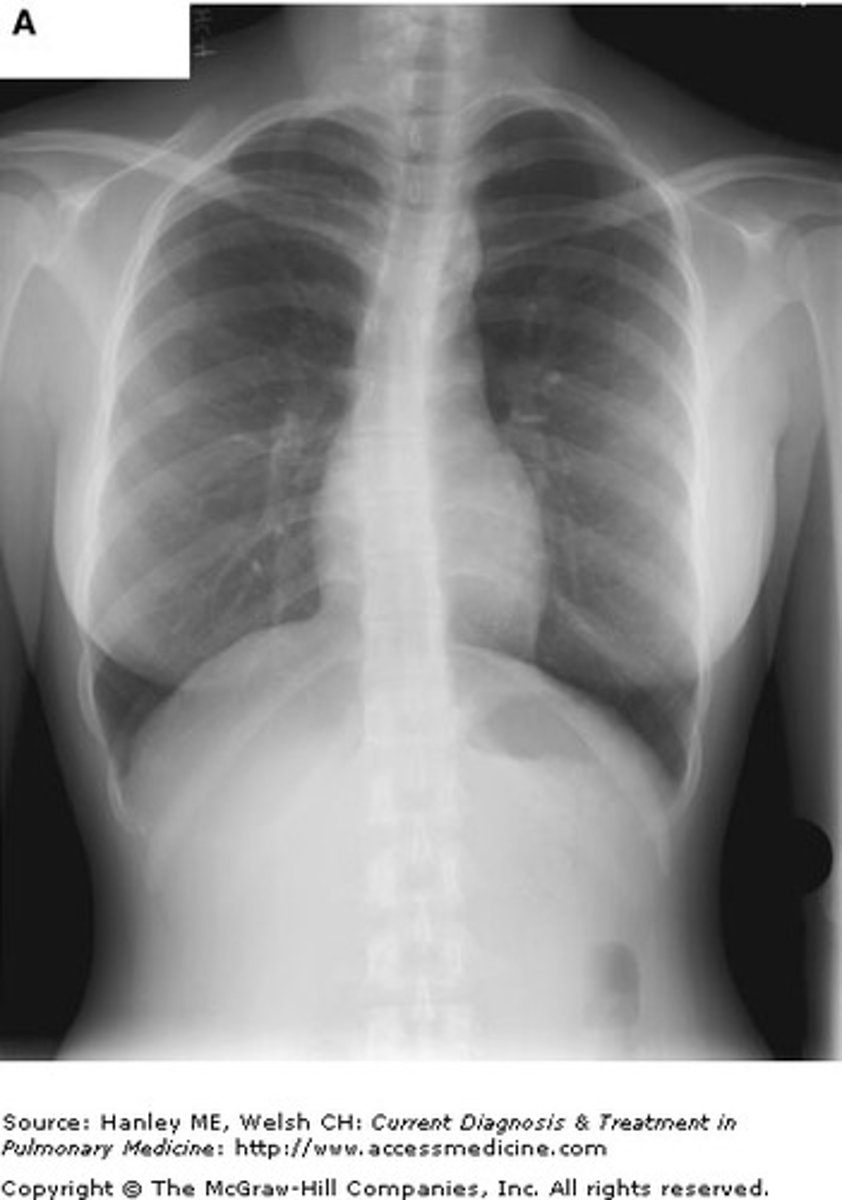 <p>The correct answer is (D). ACE inhibitors such as benazepril have a potential adverse reaction of a chronic cough. Discontinuing the ACE inhibitor is appropriate in this case while substituting this for another antihypertensive. The CXR is normal and there are no findings suggestive of pneumonia, bronchiectasis, or asthmatic bronchitis. A chronic cough is not a significant side effect of amlodipine.</p>