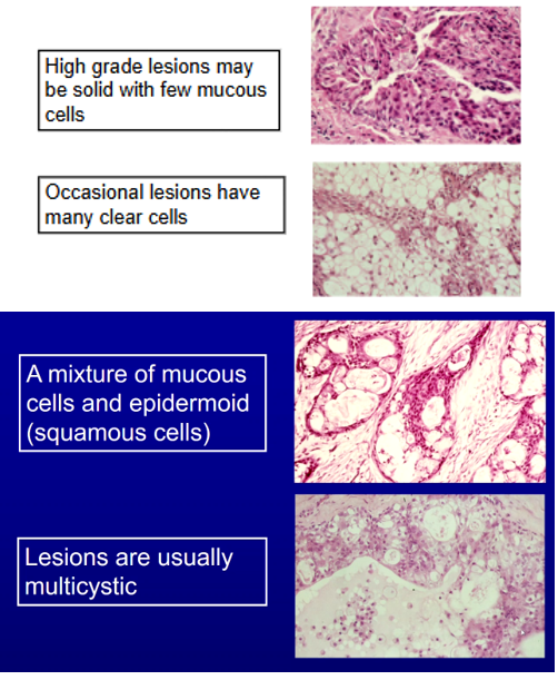 <p><span>A mixture of Mucous Cells and Epidermoid Cells (in the name)</span><br><span>- Lesions are usually multicystic</span><br><br><span>High Grade Lesions may be solid with few mucous cells</span><br><br><span>Occasional Lesions have many clear cells</span></p>