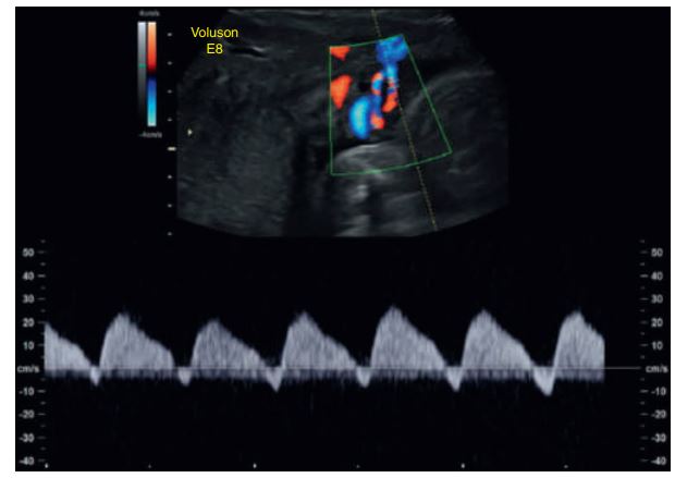 <ul><li><p>During the fetal cardiac cycle, there is umbilical blood flow during both the pumping (systole) and filling (diastole) phases of the heartbeat. </p></li><li><p>No flow (absent end-diastolic flow) and_______ during diastole .</p></li><li><p>&nbsp;signs of fetal jeopardy and may prompt the obstetrician to do further fetal well-being testing or even to deliver the fetuses.</p></li></ul><p></p>