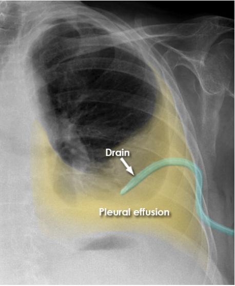 <p>Below the insertion site to avoid reverse flow.</p>