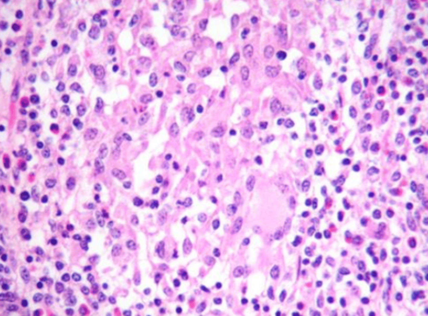 <p>what type of exudate is being shown microscopically?</p>