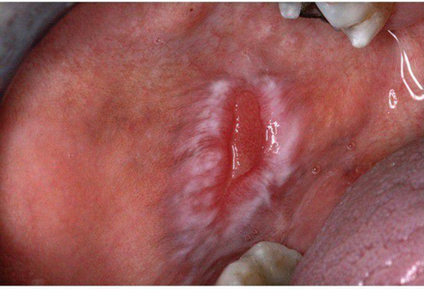 <p>An oral lesion presents with central erythema and white radiating striae. The patient also has a butterfly rash on the face. What is the most likely diagnosis?</p>