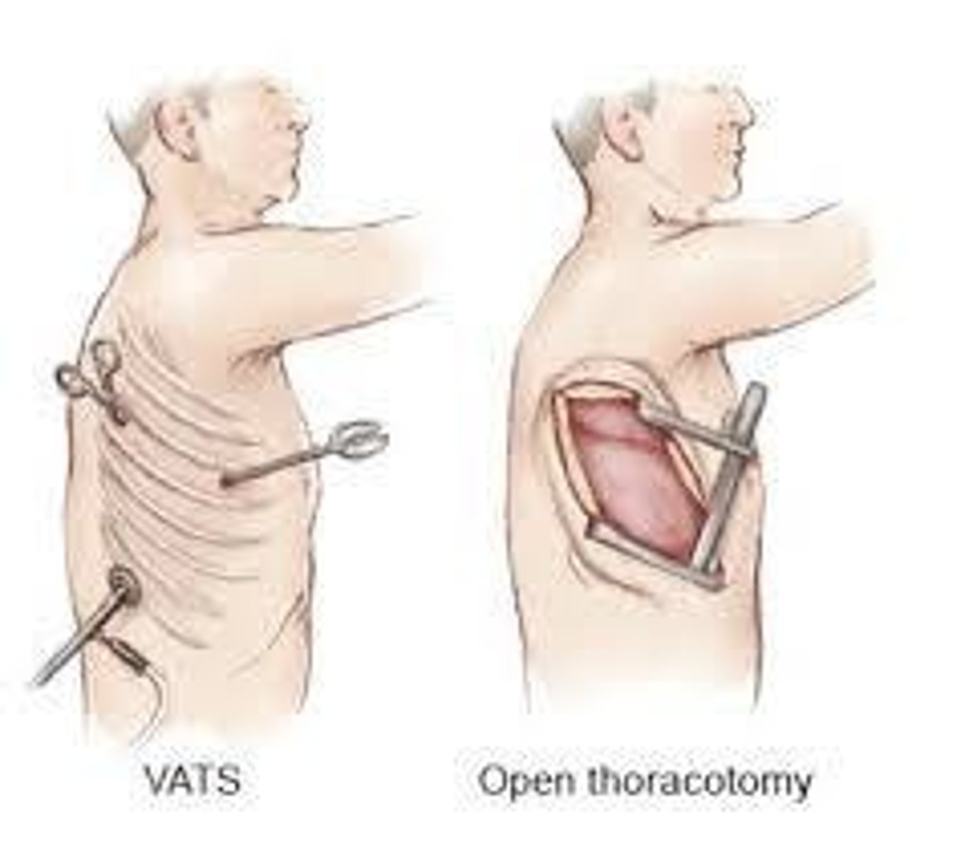 <p>VATS involves 1-3 ports and does not spread ribs, making it less invasive compared to traditional thoracotomy.</p>