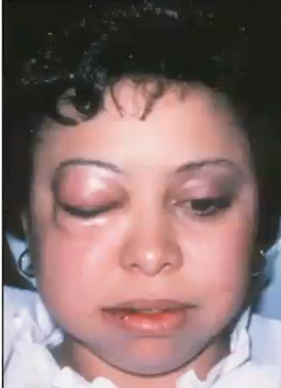 <p>swelling occurred IMMEDIATELY following dental procedure, what is the diagnosis  </p>