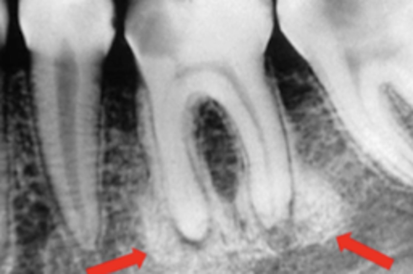 <p>Long standing infection</p>
