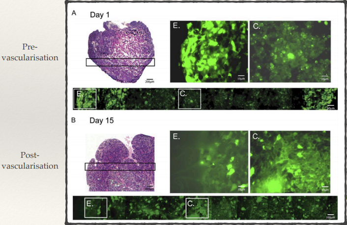 <ul><li><p>Hypoxic, nutrient-poor regions:</p><ul><li><p><strong>Autophagy is upregulated</strong>, as cancer cells adapt to low oxygen and nutrient conditions by breaking down internal components to provide energy and maintain survival.</p></li><li><p>This <strong>pro-oncogenic autophagy</strong> supports tumour growth by helping cells survive under stressful conditions.</p></li></ul></li><li><p>Pre- and post- vascularisation:</p><ul><li><p><strong>Pre-vascularisation </strong>tumours have lots more autophagy occurring in the centre of the tumour since there’s no vascularisation there. Tumours in early stages depend on autophagy <strong>to survive limited nutrient supply (starving).</strong></p></li><li><p>Having autophagy is only really important in the early stages because as tumours develop you have things like <strong>angiogenesis </strong>(new blood vessels developing), so good blood supply reaches the centre of the tumours - autophagy returns to normal.</p></li></ul></li><li><p>If autophagy is blocked (particularly in early tumours) it can cause the centre of the tumour undergo apoptosis or necrosis - so they won’t be able to survive in the centre and tumour can die.</p></li></ul><p></p>