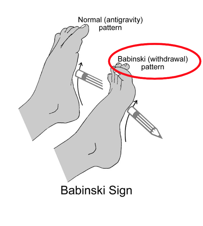 <p>Provide an example of a Babinski sign. Explain the third step.</p>