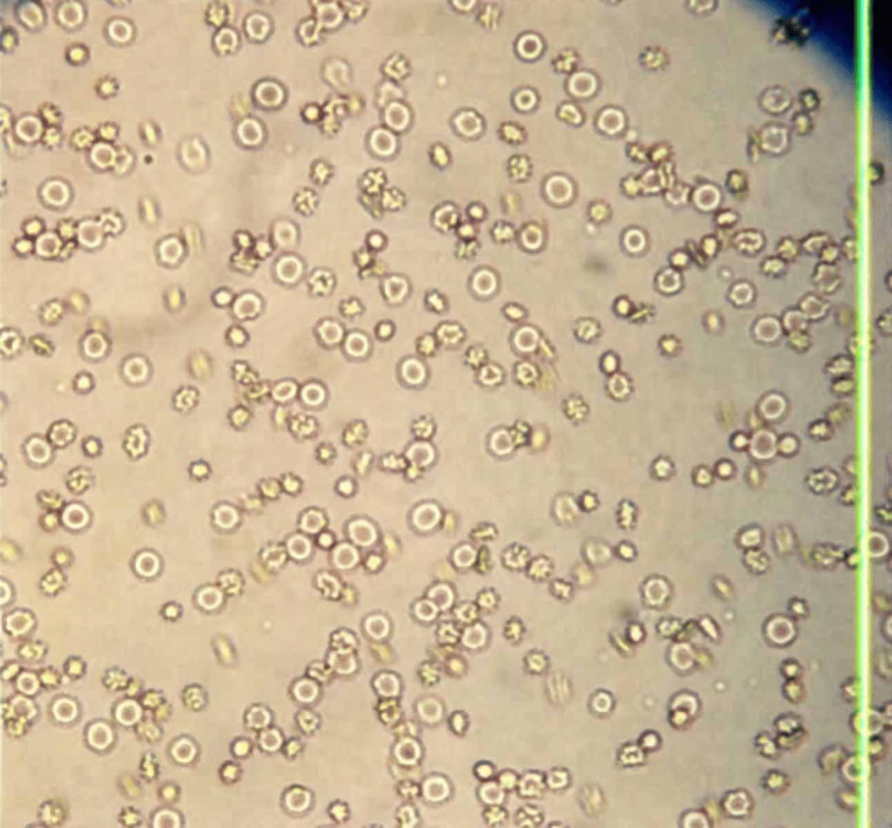 <p>A. Acute glomerulonephritis</p><p>Refer to Color Plate 52. Erythrocytes or red blood cells (RBCs) occur in small numbers (0-2/hpf) in a normal urine. Using brightfield microscopy, unstained RBCs appear as colorless discs with an average size of 7 um in diameter. Increased or large numbers of RBCs are commonly seen with acute glomerulonephritis, renal calculi, acute infections, and menstrual contamination.</p>