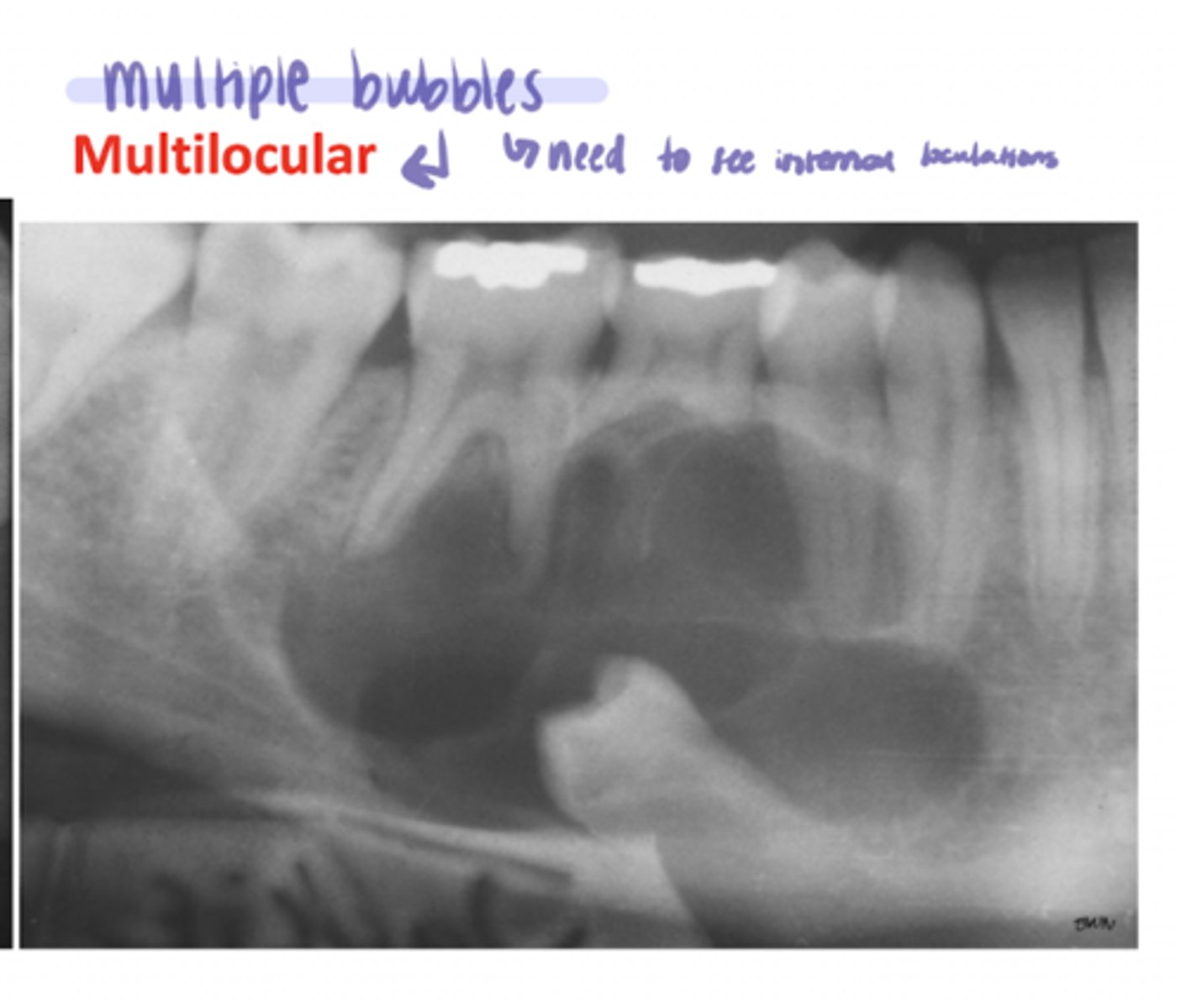 <p>radiolucent; multiple bubbles (need to see internal loculations)</p>