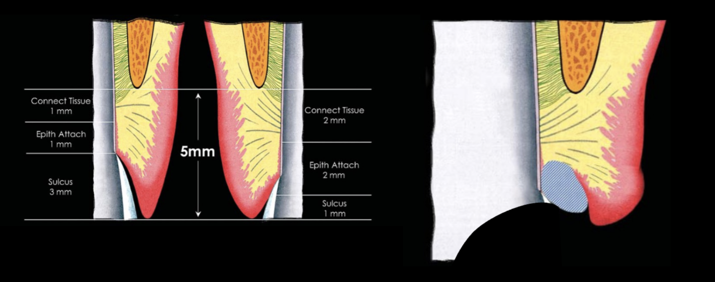 <p>in the sulcus, ~1-3 mm; so don’t be aggressive </p>