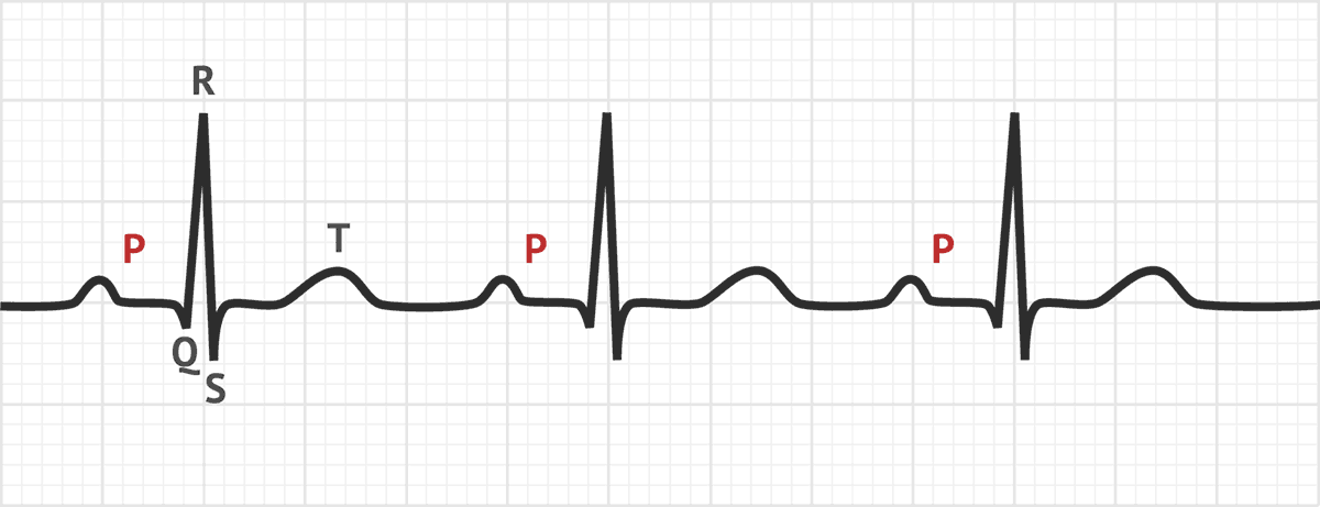 Atrial depolarization

Occurs just prior to atrial contraction