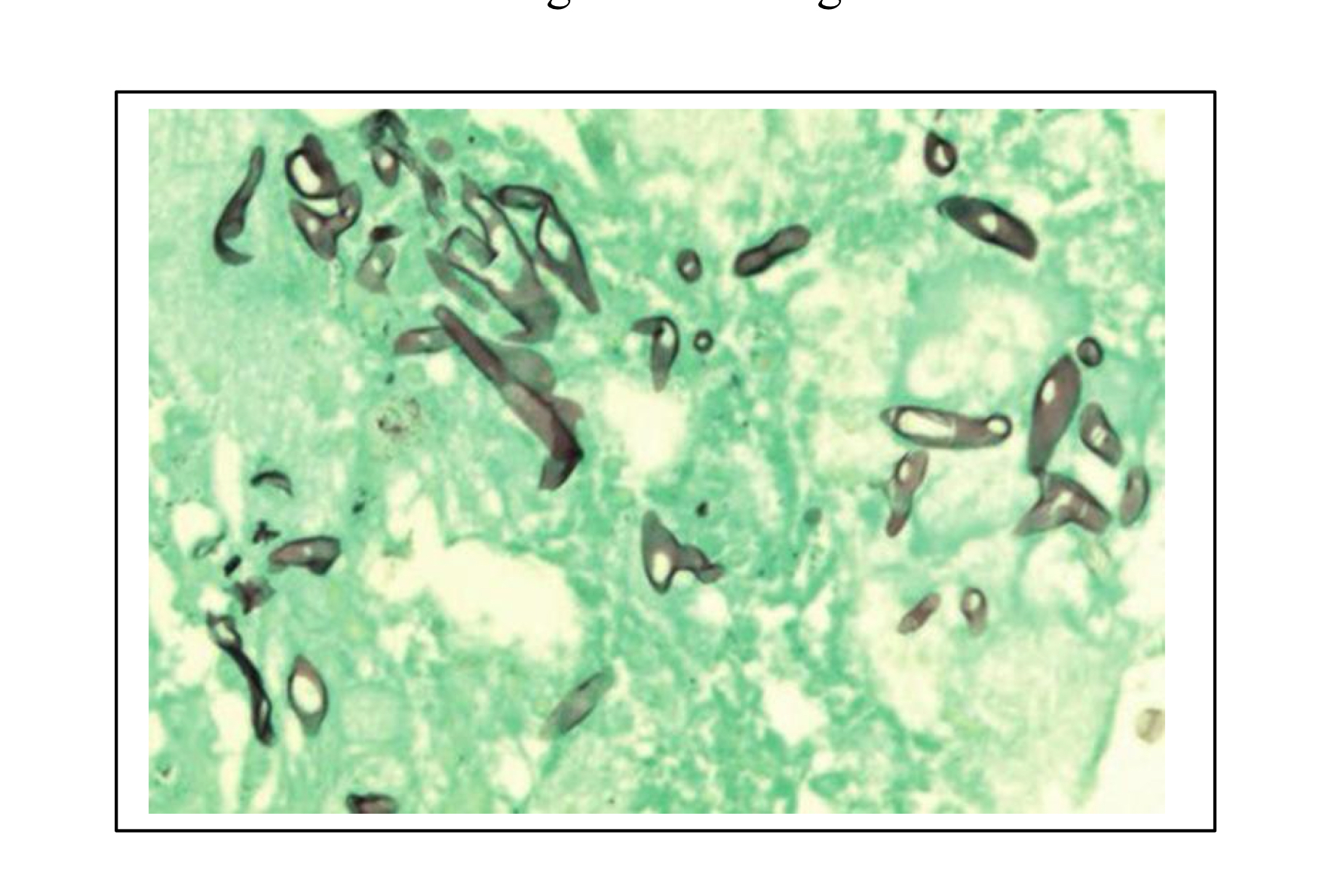 <ul><li><p>Brown stained aseptate hyphae (no segmented appearance)</p></li><li><p>Non-parallel walls</p></li><li><p>Non-dichotomous branching (two equal parts, think peace sign)</p></li></ul><p></p>