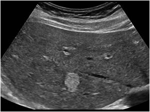 <p>52-year-old woman is referred to ultrasound to rule out gallstones. During the exam, a hyperechoic mass was seen in the right lobe measuring 3.7× 2.5cm. What are possible diagnoses?</p>