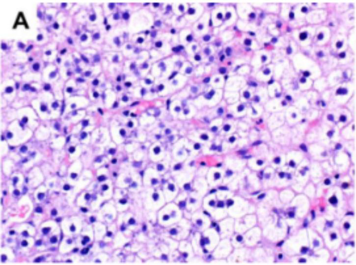 <p>special stains of glycogen degeneration</p>