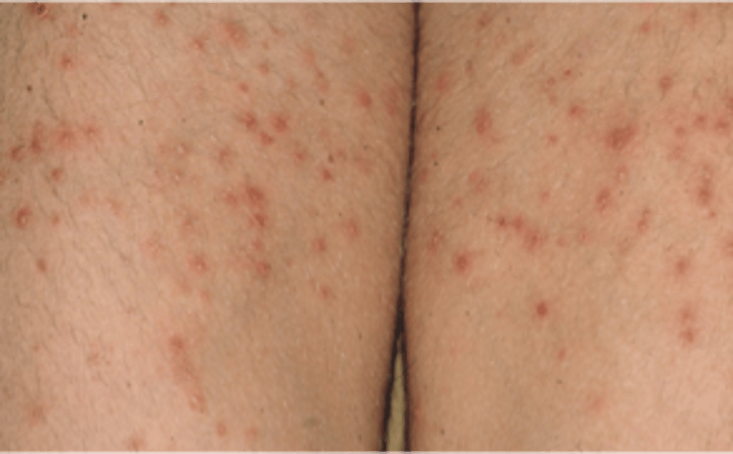 <p>name this skin pathology</p>