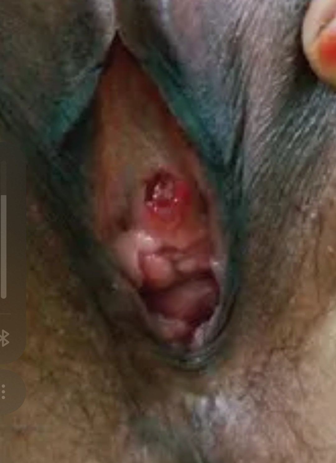 <p>Femme 59 ans, érythème et tumefaction de l'urètre distal</p><p>1) diagnostic</p><p>2) clinique</p>
