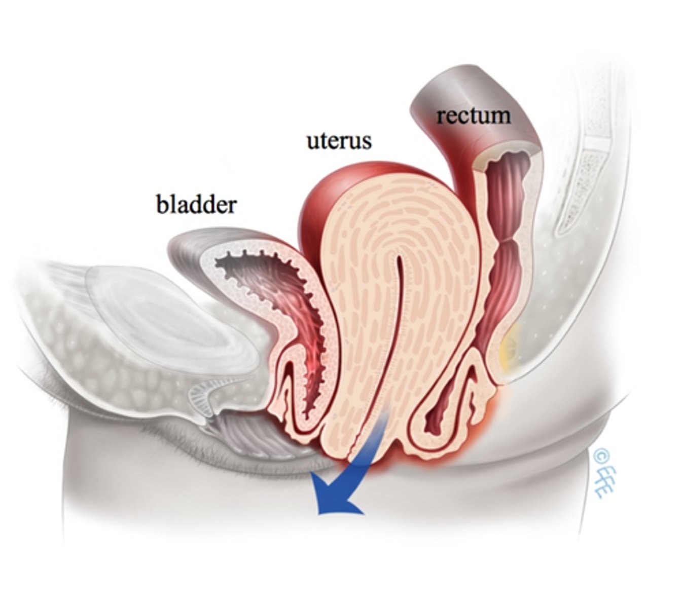 <p>Hysterectomy postop:</p><p>- foley cath (hard to insert d/t swelling, infection++)</p><p>- Suprapubic cath → prevent UTI + urinary drainage + reduce strain </p><p>- strict I &amp; O</p><p>- POD2 → ambulate to BR </p><p>- encourage bladder emptying</p>