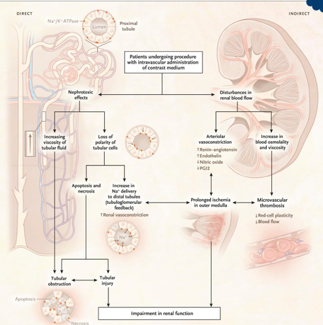 <p>-intravenous (CT scans) or intravenous (left-heart catheterization) administration of iodinated contrast</p><p>-intense arteriolar vasoconstriction</p><p>-hyperosmolality and hyperviscosity of vasa recta → thrombosis</p><p>-direct toxicity to proximal tubule cells</p><p>-usually reversible</p>