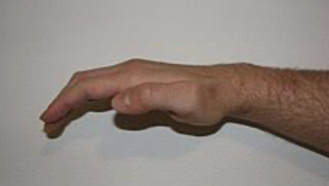 <p>weakness of extensor muscles that pull the thumb parallel with the fingers and flexion of MCP and IP are weakened</p>