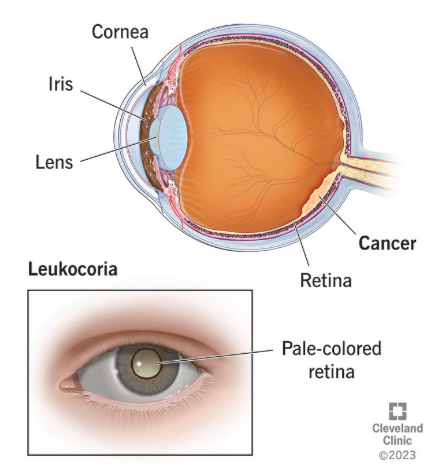 <p>Retinoblastoma </p>