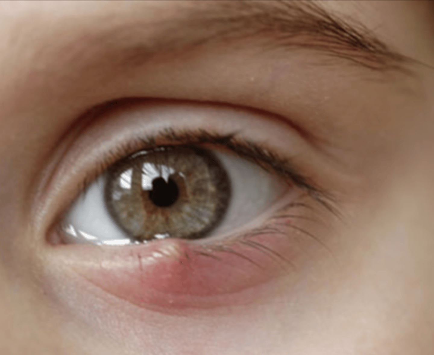 <p>What condition does this patient most likely have?</p>