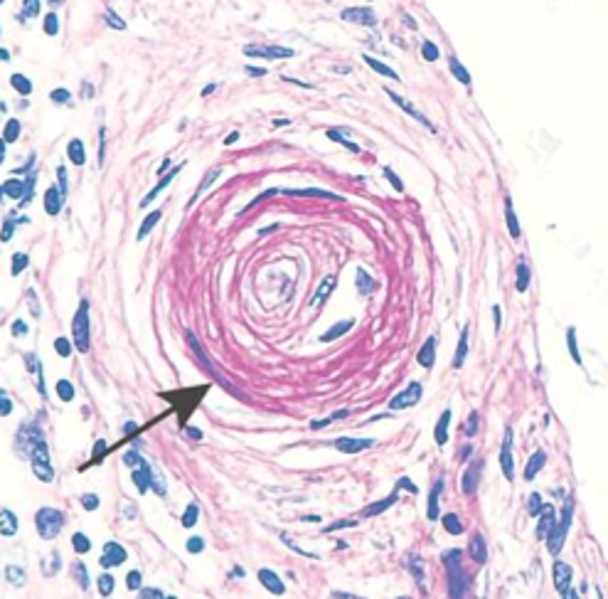 <p>abnormal hardening of the walls of an artery or arteries</p>