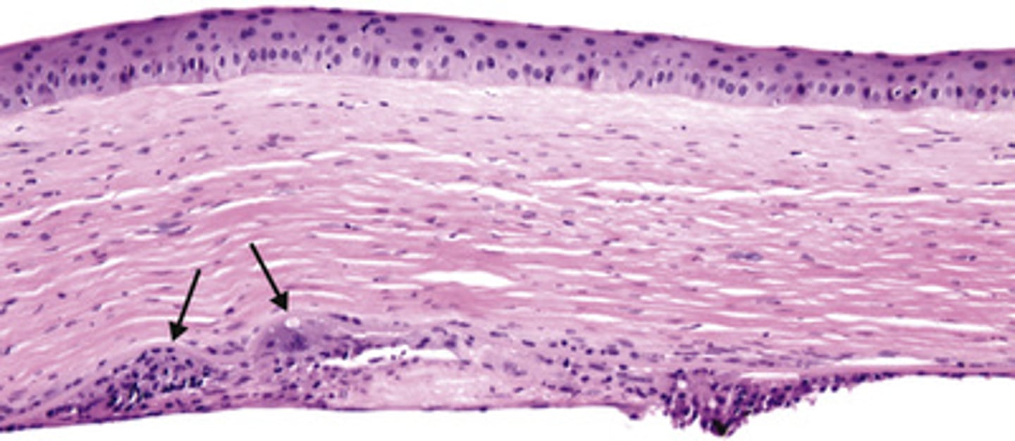 <p>Information for Condition:</p><p>Virus that can cause keratitis (granulomatous inflammation centered on Descement membrane) and corneal ulcers:</p><p>-Will see scarring, neovascularization &amp; deep granulomas</p>
