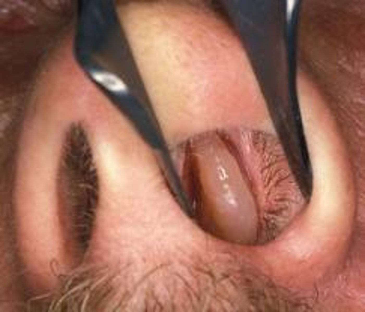 <p>Stalk-like growth from Mucous membrane</p>