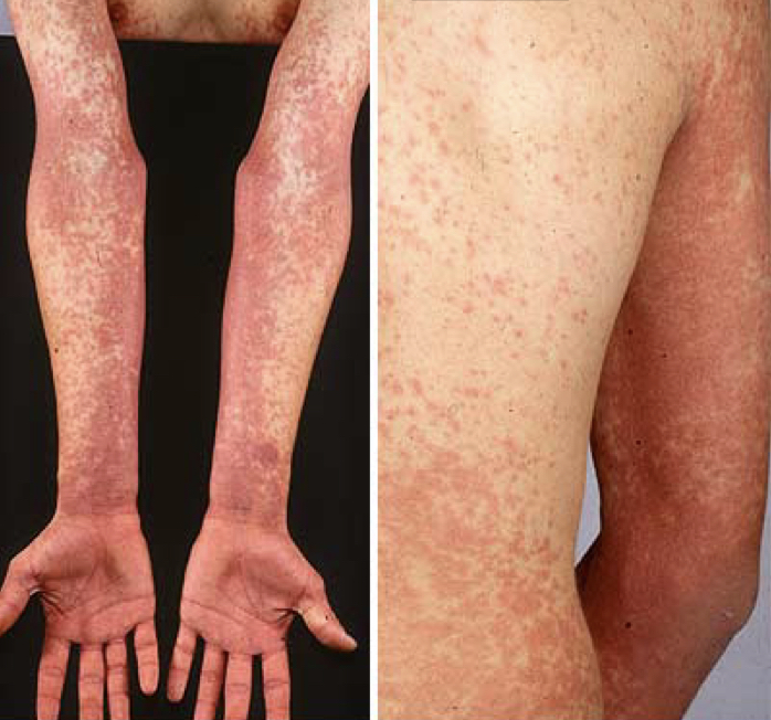 \
\
\
Scarlet fever: Streptococcal skin infections 