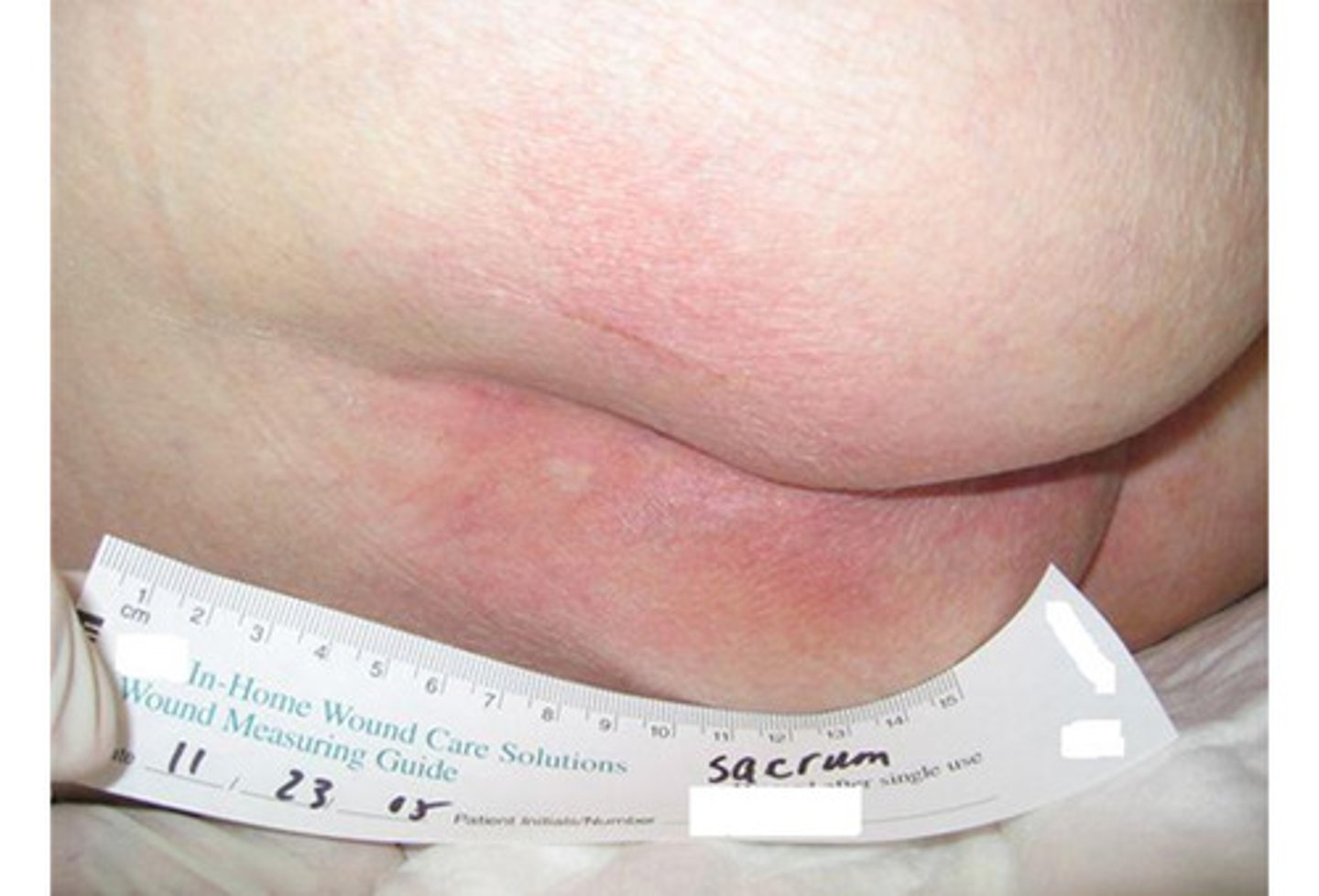 <p>intact skin; red/irritation; unblanchable</p>