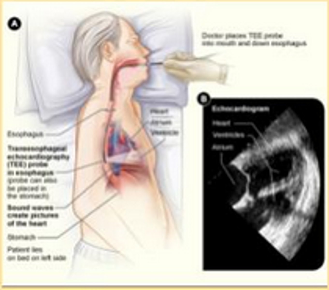 <p>ultrasound test that examines cardiac function and structure by using an ultrasound probe placed in the esophagus, which provides views of the heart structures</p>