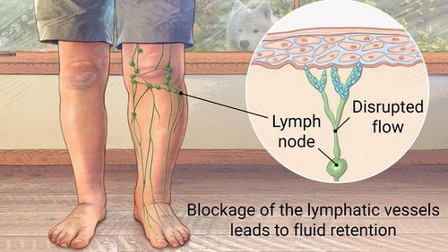 <p>Severe localized edema caused by anything that prevents normal return of lymph to blood.</p>