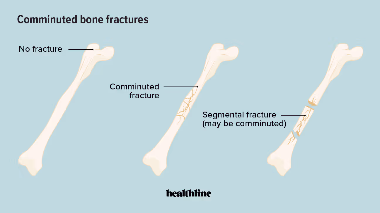 <p>A comminuted fracture is when the bone breaks into three or more pieces, often due to high-impact trauma.</p>