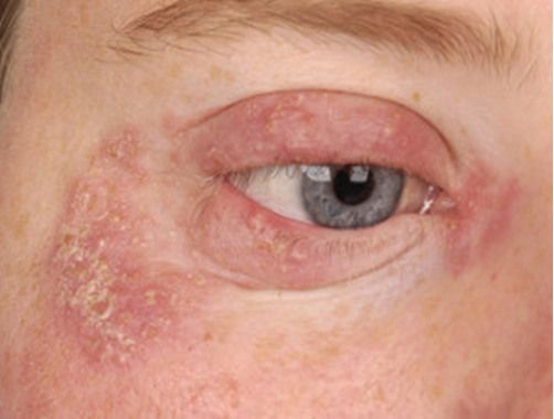 <ul><li><p>fungal infection - Rare&nbsp;</p></li></ul><p></p>