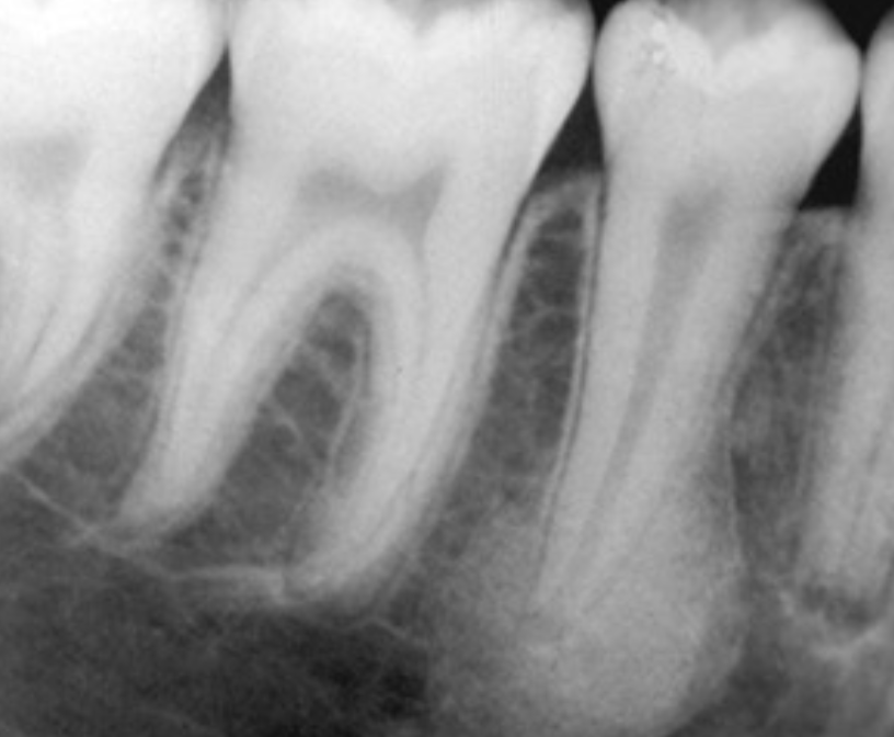 <p>can mimic sclerosing osteitis (condensing osteitis)</p><ul><li><p>PDL space remains uniform</p></li><li><p>narrow transition zone between IO and adjacent bone</p></li><li><p>sometimes mild root resorption</p></li></ul><p></p>