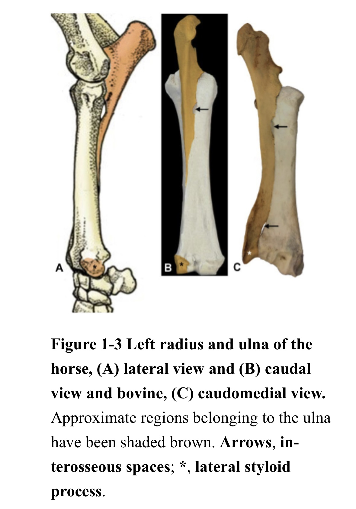 <ol><li><p>Proximal ulna present + Fuse to radius</p></li><li><p>Body of ulna absent → Greatly reduce in size → Do not extend up to radius</p></li><li><p>Distal ulna present + Fuse to radius → Medial styloid process + Lateral styloid process</p></li><li><p>Small interosseous space → No rotation</p></li></ol><p></p>