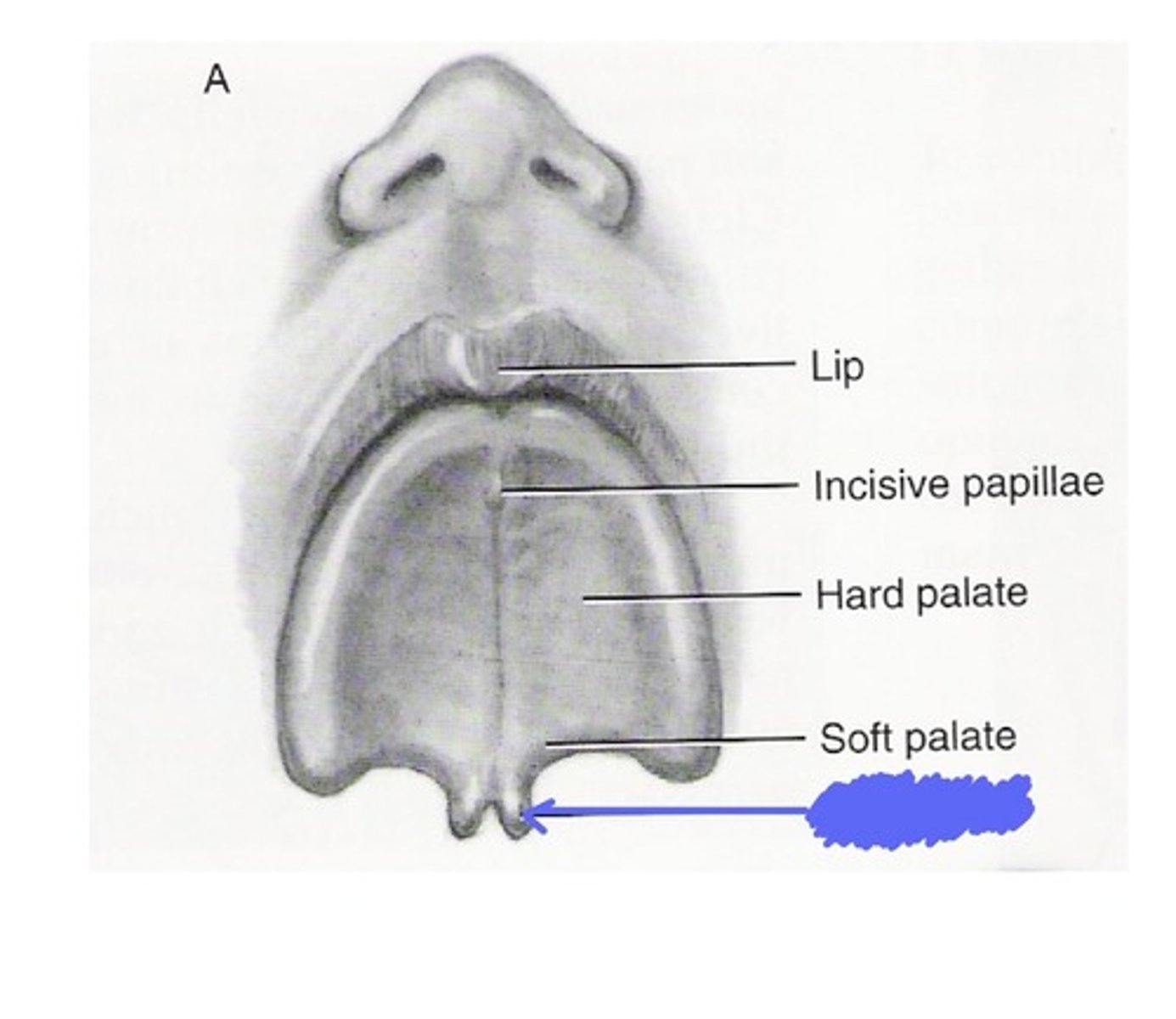 <p>This is the least complicated example of cleft palate.</p>