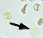 <p>Term used to refer to RBCs that only contains the cell membrane due to leakage of Hgb caused by hemolysis</p>